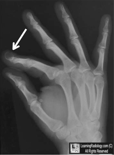 Epidermal Inclusion Cyst